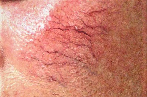 Rozácea - egy nagyon kellemetlen rózsaliget az arcbőrön